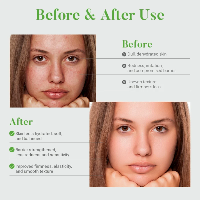 Comparison image showing a woman's face before and after skincare treatment, highlighting skin improvements like reduced redness and improved texture.